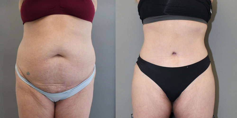 Tummy Tuck