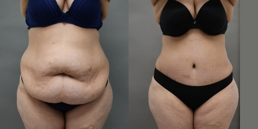Tummy tuck