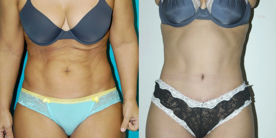 Abdominoplasty