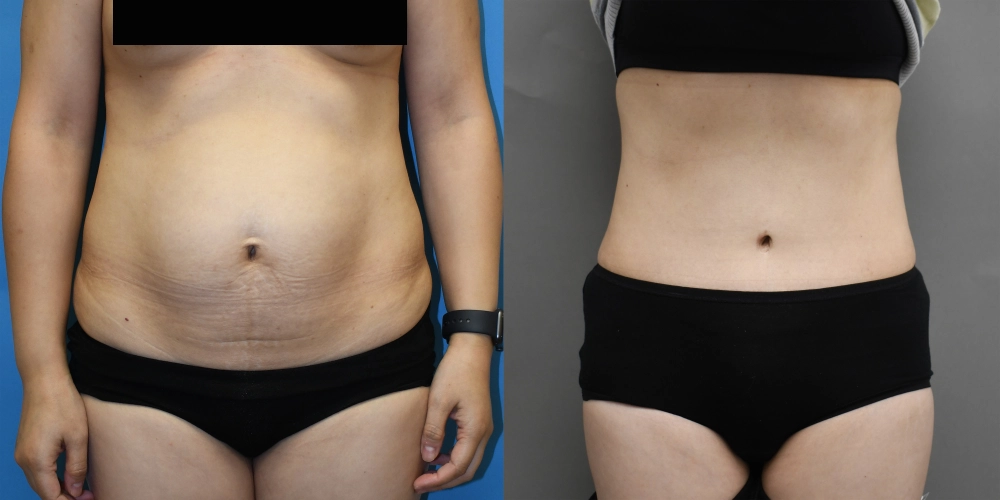 tummy tuck