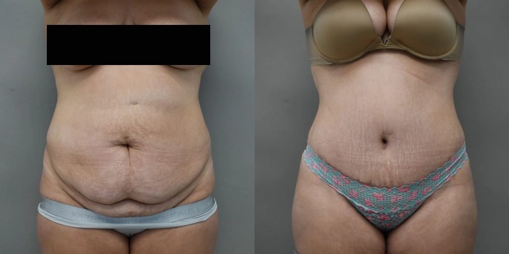 Tummy tuck