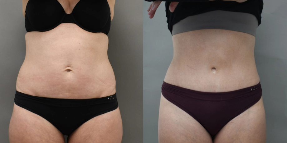 Tummy tuck
