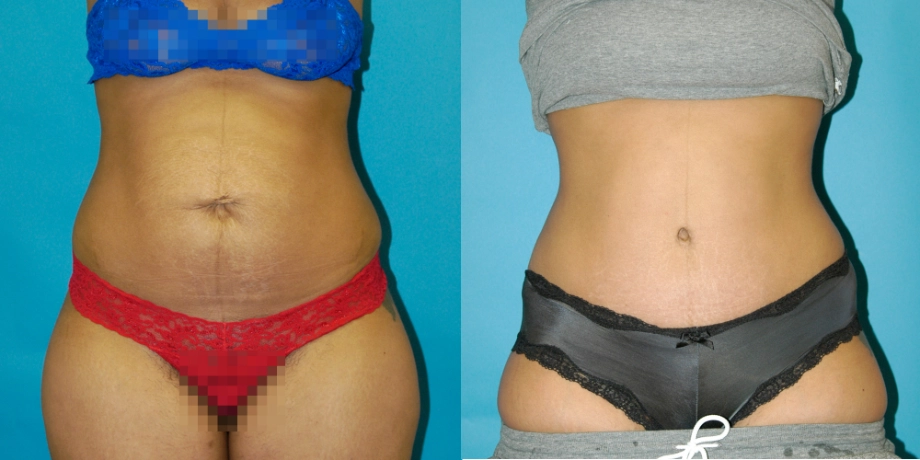 Tummy tuck