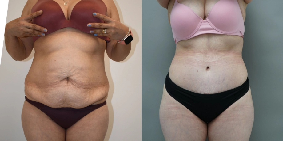 tummy tuck