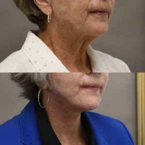 Why My Deep-Plane Facelift Is Different From a Traditional SMAS Facelift I Dr.Afshin Parhiscar
