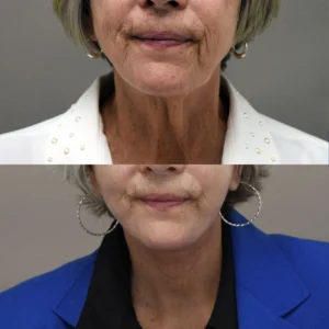 Beyond the Deep Plane: Technical Details That Make My Facelift Different I Dr.Afshin Parhiscar