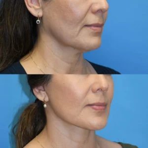 Why My Deep-Plane Facelift Is Different From a Traditional SMAS Facelift I Dr.Afshin Parhiscar