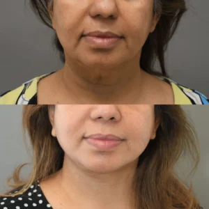 Beyond the Deep Plane: Technical Details That Make My Facelift Different I Dr.Afshin Parhiscar