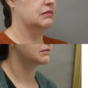 Why My Deep-Plane Facelift Is Different From a Traditional SMAS Facelift I Dr.Afshin Parhiscar