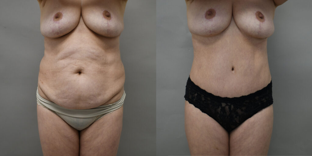 tummy tuck