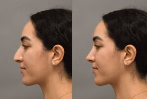 Role of Imaging in rhinoplasty I Dr.Afshin Parhiscar