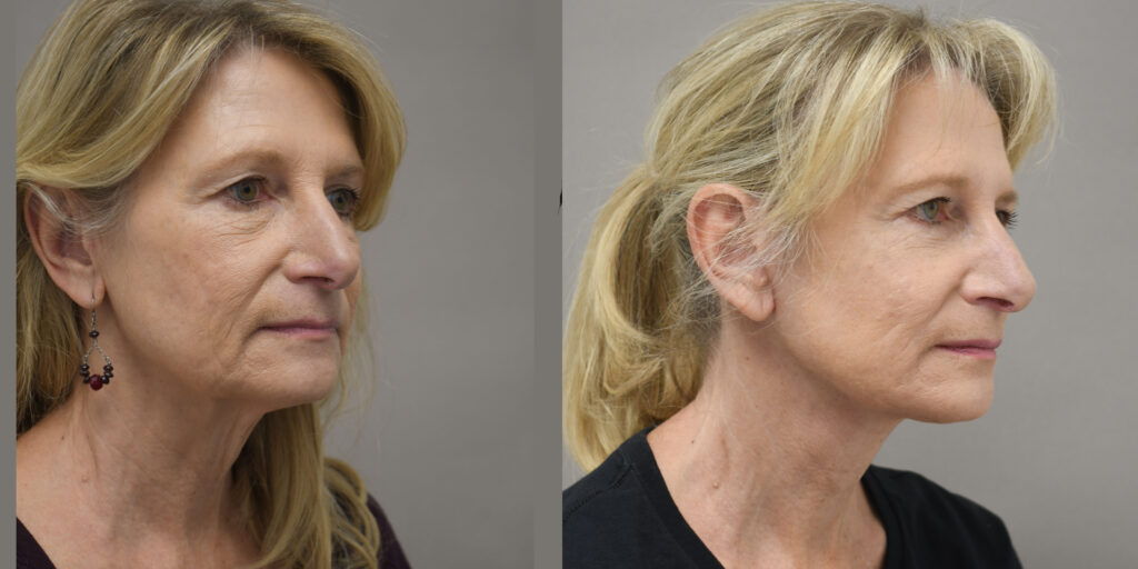 necklift