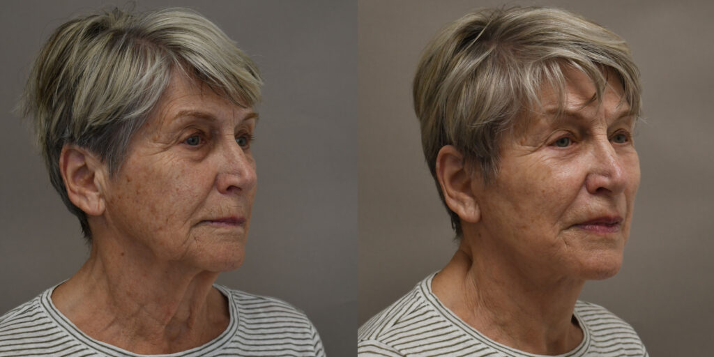 deep plane facelift