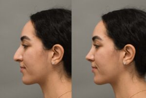 Role of Imaging in rhinoplasty I Dr.Afshin Parhiscar