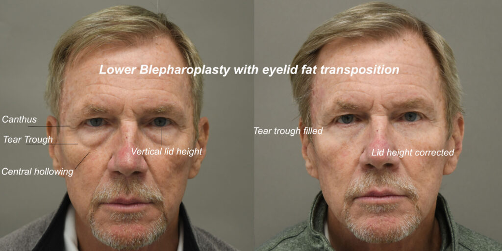 Blepharoplasty