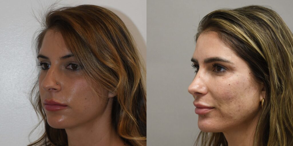 rhinoplasty