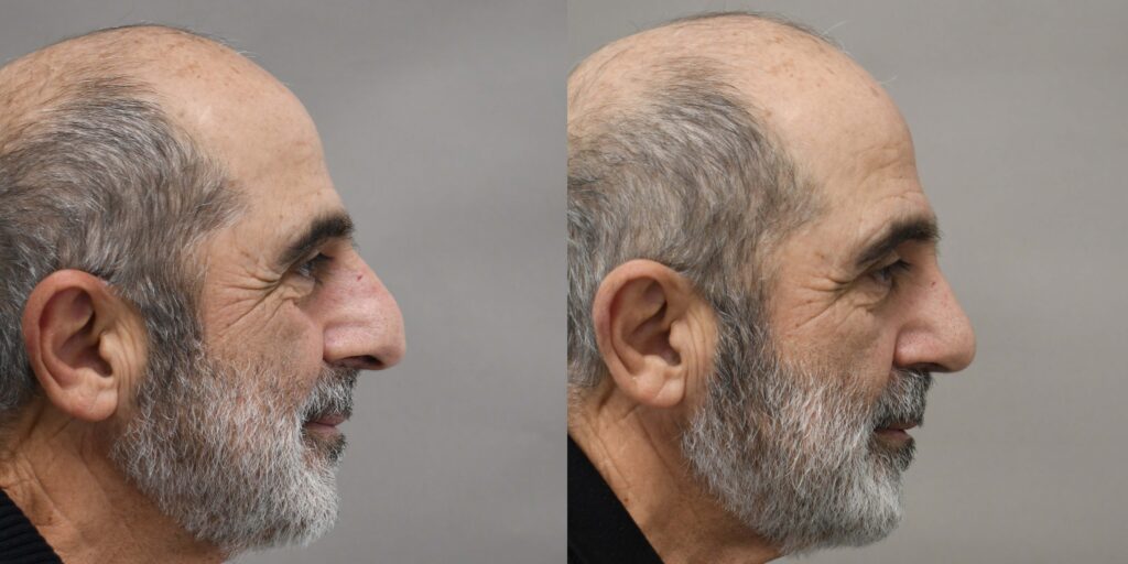 rhinoplasty male