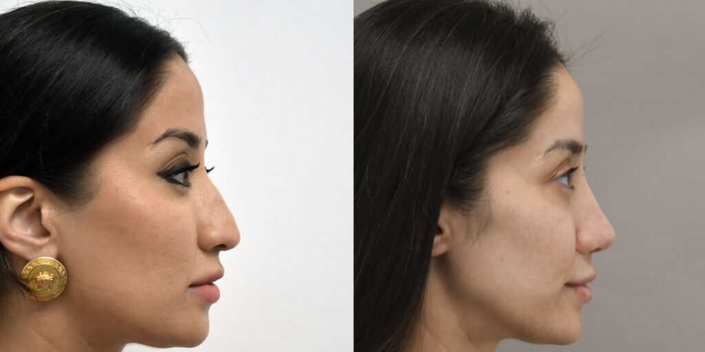 rhinoplasty