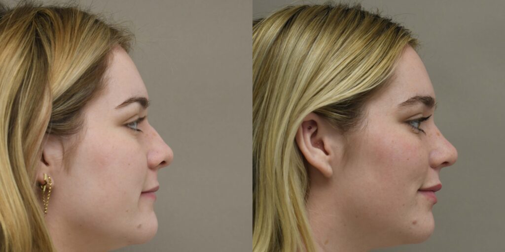 rhinoplasty