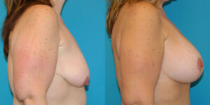 Breast Lift vs. Breast Augmentation: Do I Need a Lift, Implants, or Both? 3 I Dr. Afshin Parhiscar breast lift
