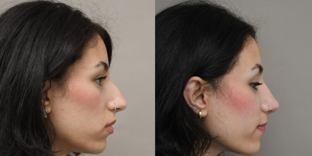 rhinoplasty