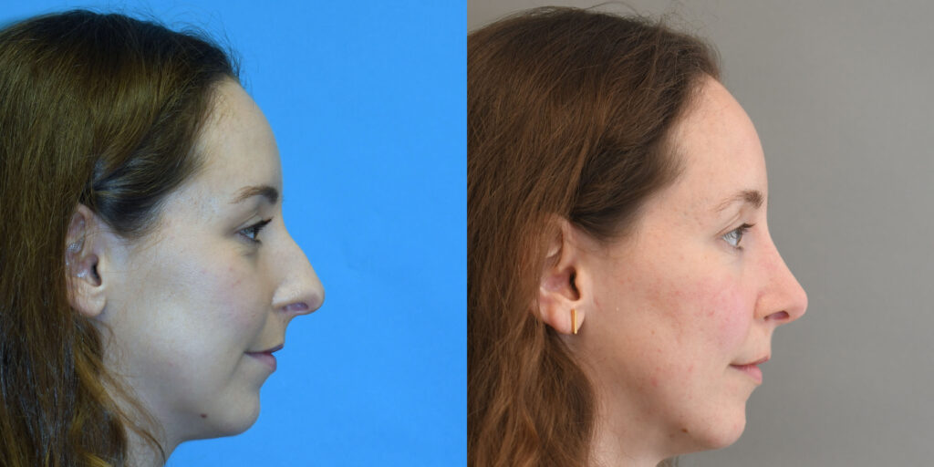 rhinoplasty