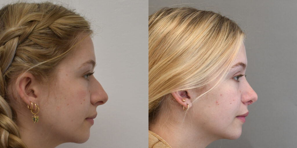 female rhinoplasty